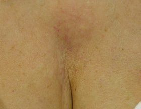 teleangiectasia - after
